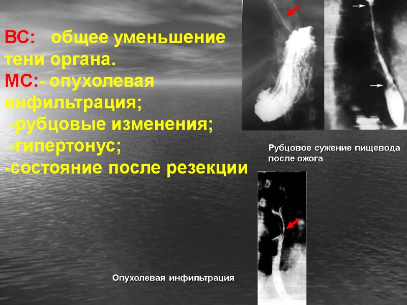 ВС:   общее уменьшение тени органа. МС:- опухолевая инфильтрация;   -рубцовые изменения;